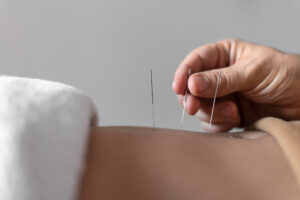 terapi akunpuntur termasuk Cara Mengatasi Ejakulasi Dini pada Pria 